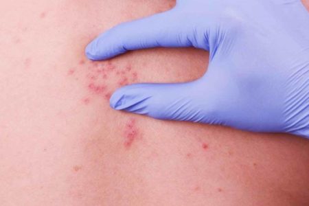 La vacuna contra la varicela reduce el riesgo de contraer la “culebrilla”