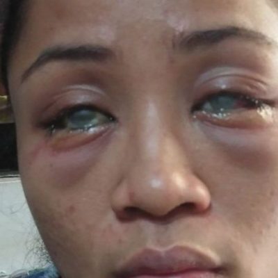 Mujer queda ciega tras novio de su pareja arrojarle ácido en Filipinas