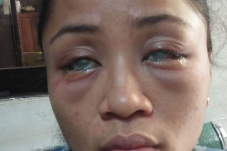 Mujer queda ciega tras novio de su pareja arrojarle ácido en Filipinas